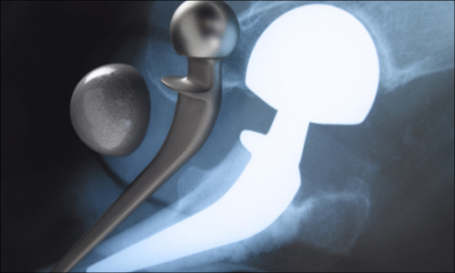 Federal Judge Finalizes $245m Award to Plaintiffs in Johnson & Johnson Hip Implant Injury Bellwether Case
