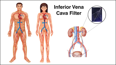 IVC Blood Filter Dangers